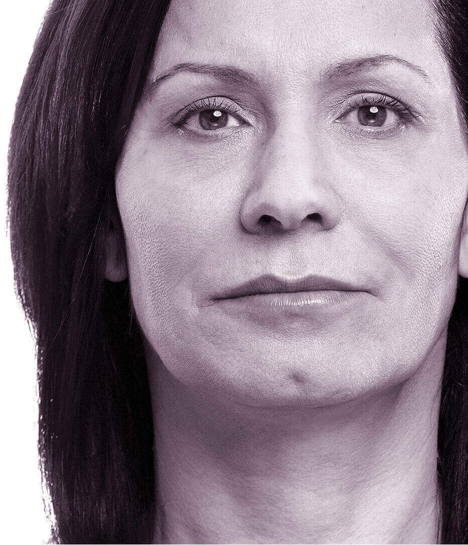 fronsrimpel verwijderen kosten fronsrimpel verwijderen kosten